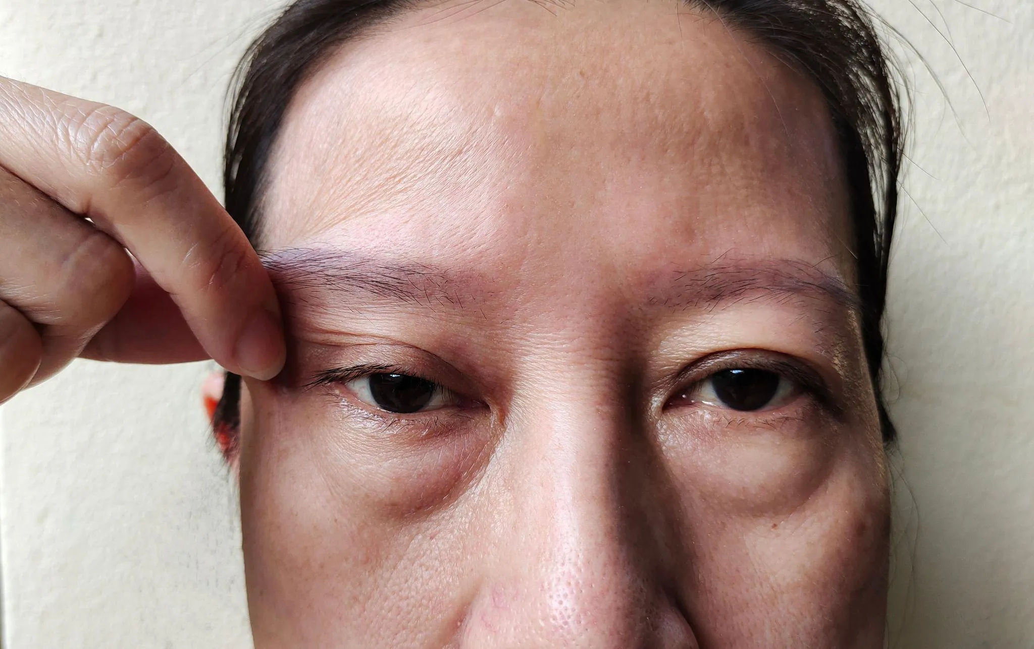 片目のまぶたが下がる眼瞼下垂の治し方！種類や原因も解説